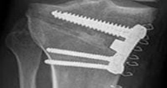 Osteotomies Around the Knee
